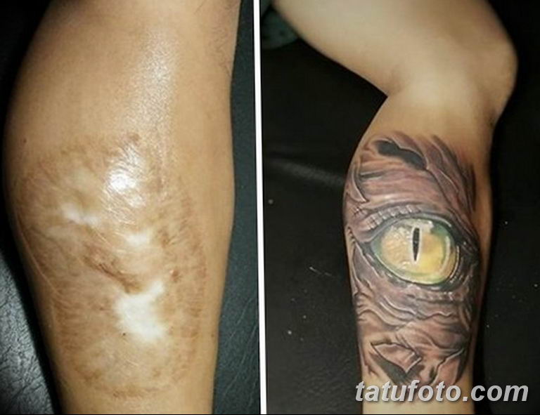 Фото тату на ожог