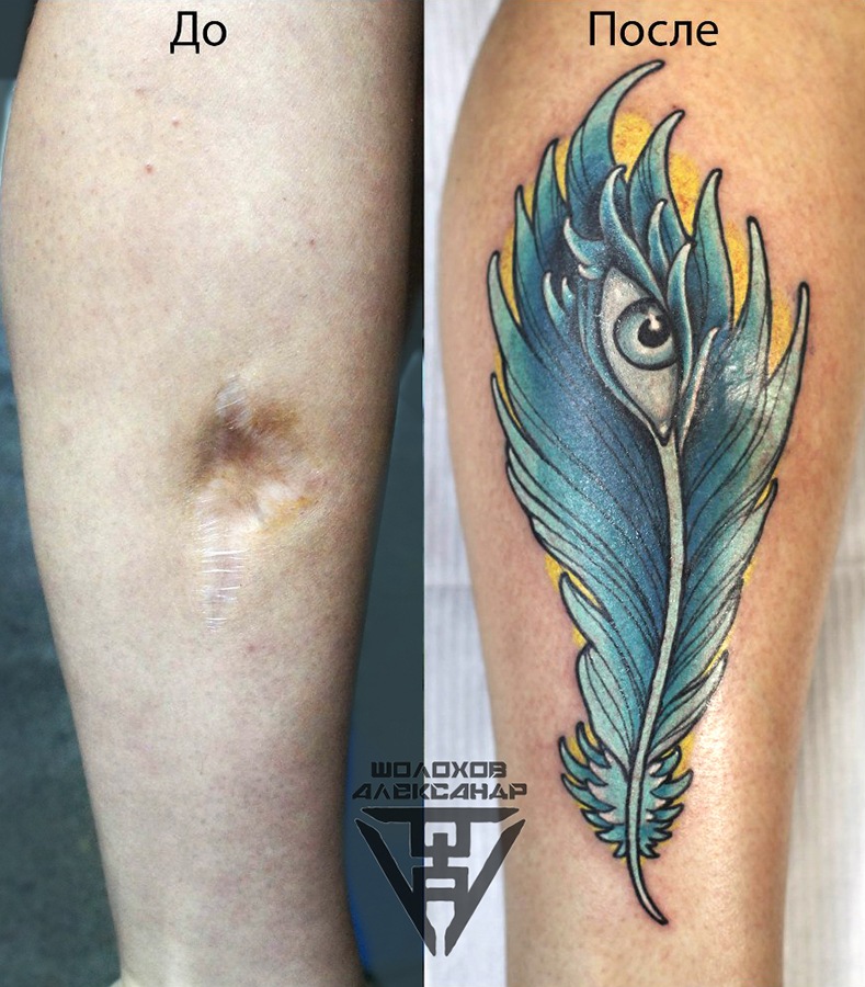 Перекрытие шрамов татуировкой